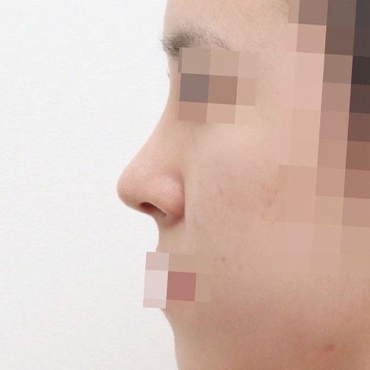 after photo: 콧대(자가조직), 콧대(보형물)