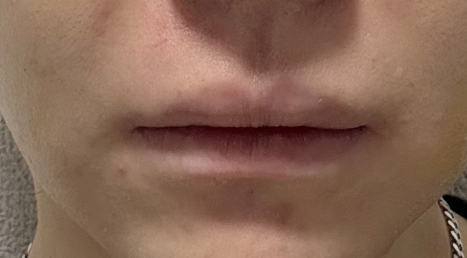 after photo: 脂肪溶解注射(顔)