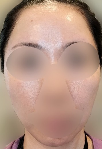 before photo: ルメッカ