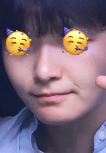 after photo: 비중격만곡증수술, 콧대(보형물), 코끝(자가연골)