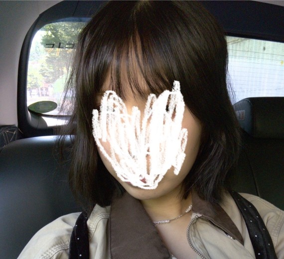 before photo: 턱끝필러