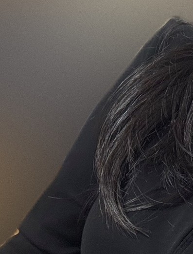 after photo: 팔지방분해주사