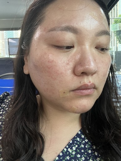 after photo: 점제거시술, V레이저