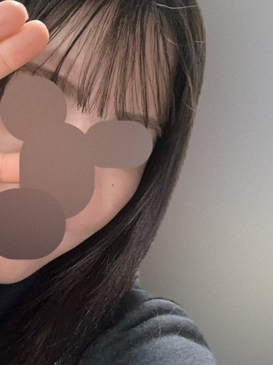 after photo: ララピール(LHAピーリング)