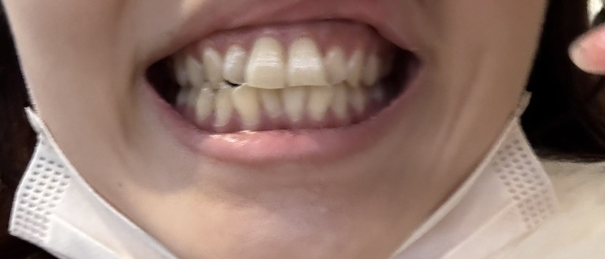 before photo: ホワイトニング