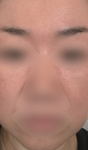after photo: エクソソーム, エリシスセンス
