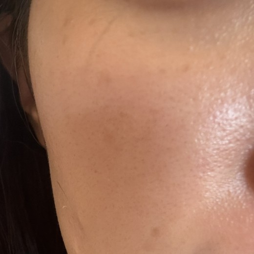 after photo: IPL(光/フォト治療), 診断・検査