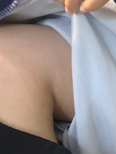 after photo: 팔지방분해주사