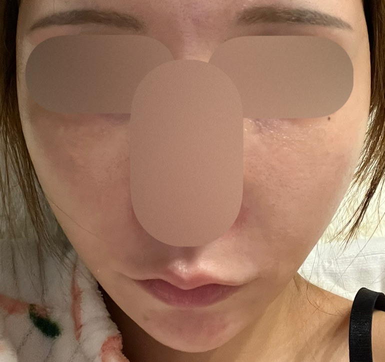 IPLフォトフェイシャル（全顔2周）＋エレクトロポレーション（薬剤1種