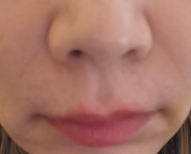 after photo: 脂肪溶解注射(顔)