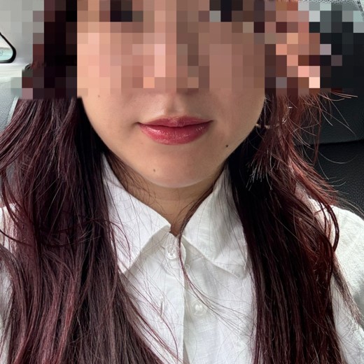before photo: インモード