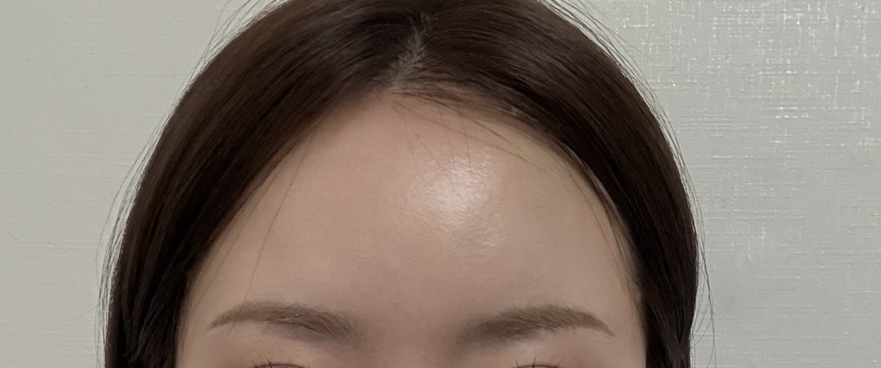 after photo: 이마필러