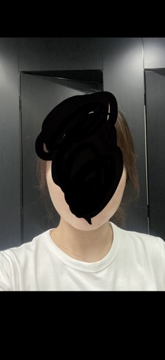 after photo: 윤곽주사, 얼굴지방분해주사