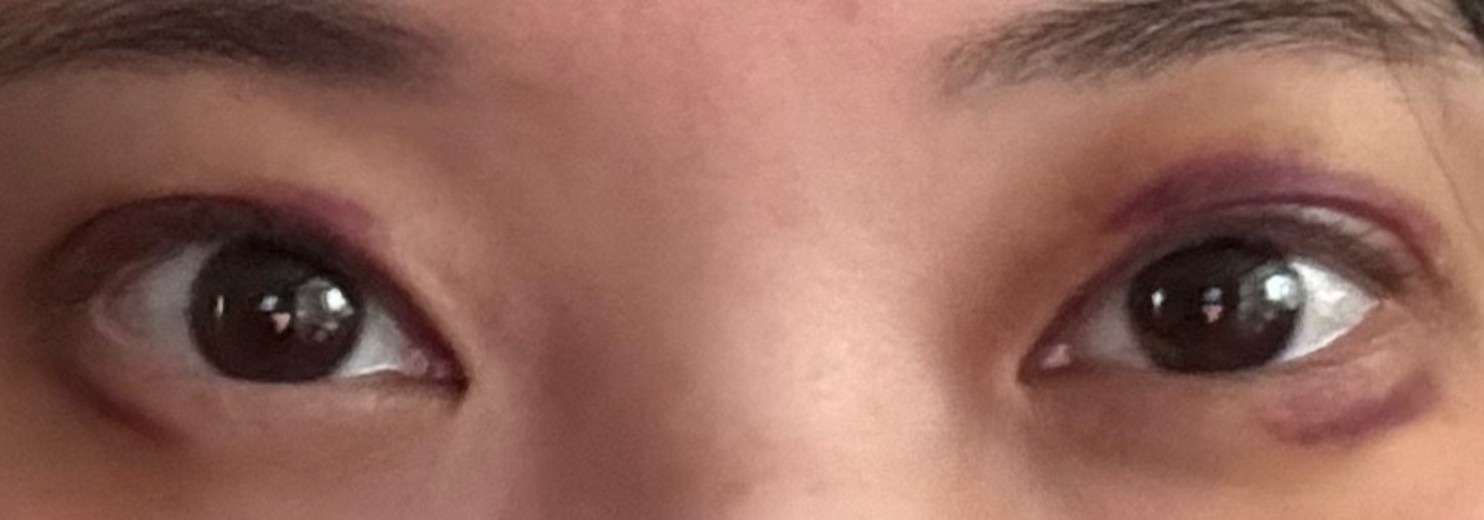 after photo: 눈재수술, 눈매교정