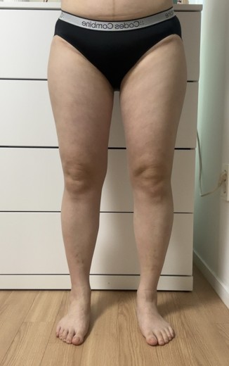 after photo: 허벅지지방흡입