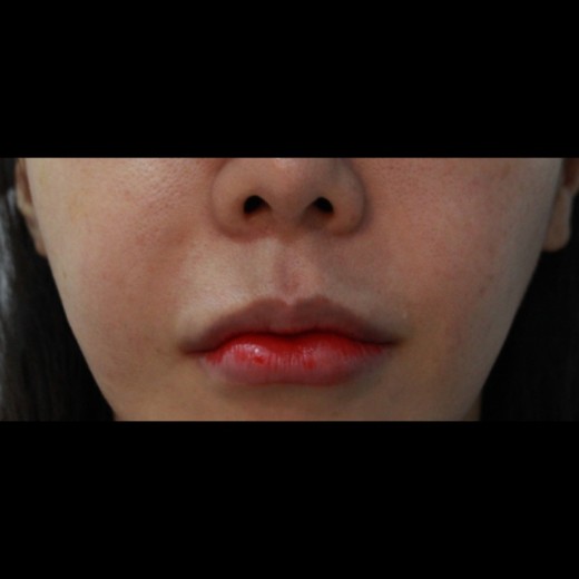 before photo: 인중축소술