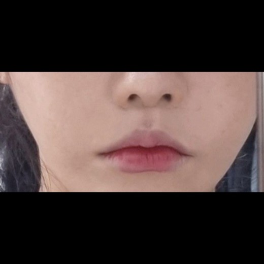 after photo: 인중축소술