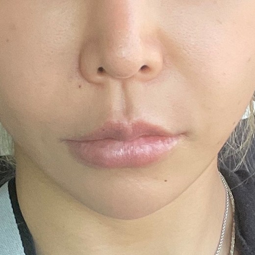 before photo: 인중축소술