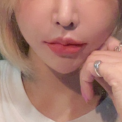 after photo: 인중축소술