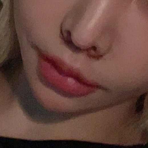 after photo: 인중축소술