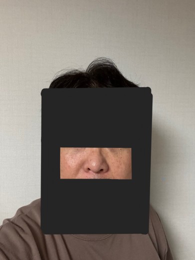 after photo: 눈밑지방재배치