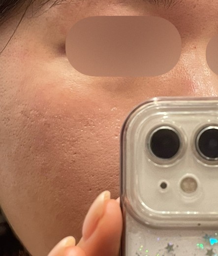 before photo: 여드름주사, 네오빔