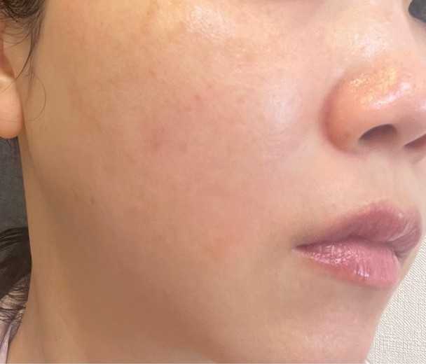 after photo: エレクトロポレーション