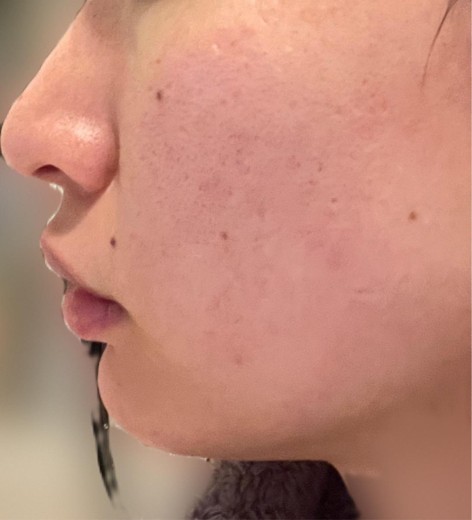 before photo: ヴェルベットスキン