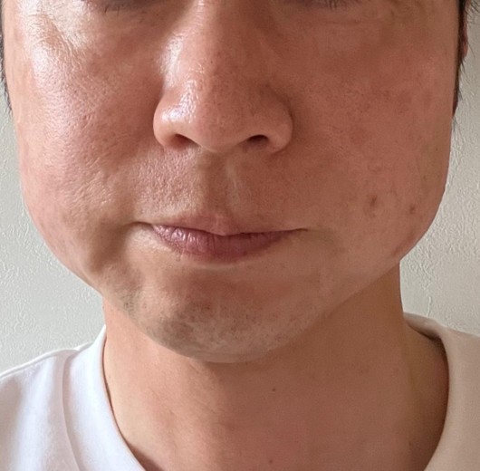 after photo: ハイフ(HIFU)