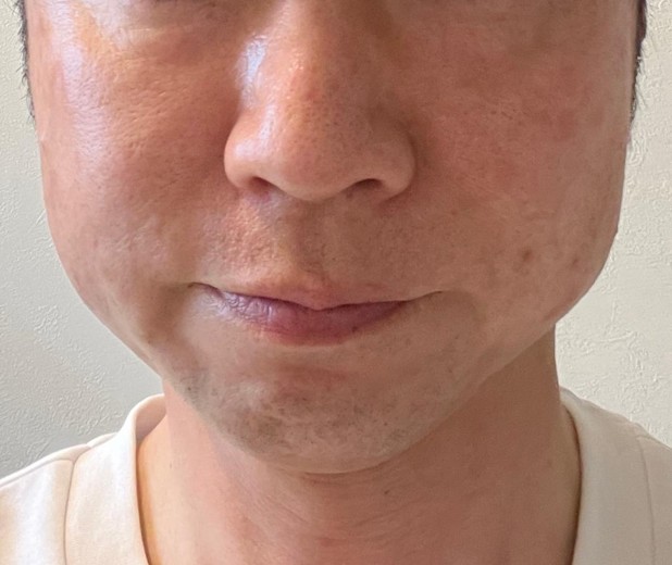 before photo: ハイフ(HIFU)