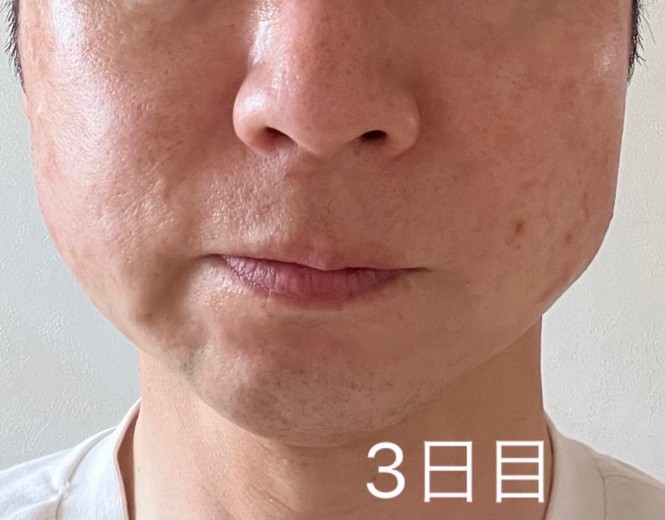 after photo: ハイフ(HIFU)