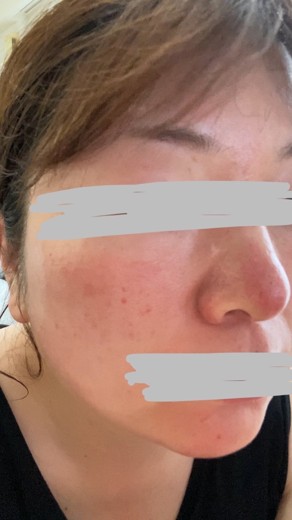 after photo: ダーマペン