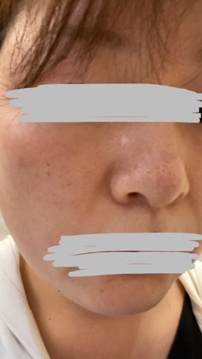 before photo: ダーマペン