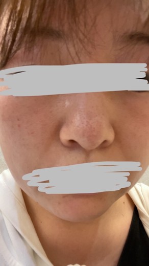 before photo: ダーマペン