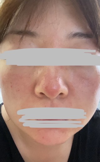 after photo: ダーマペン
