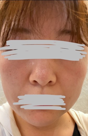 before photo: ダーマペン