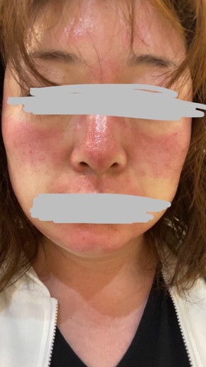 after photo: ダーマペン