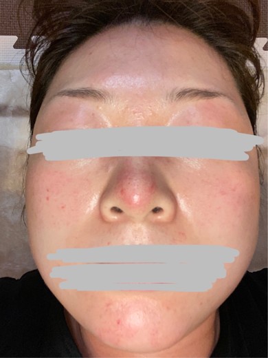 after photo: ダーマペン