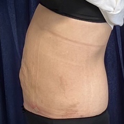 after photo: 脂肪吸引(腹部)