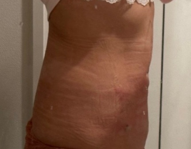 after photo: 脂肪吸引(腹部)