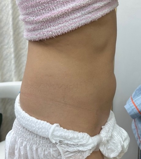before photo: 脂肪吸引(腹部)