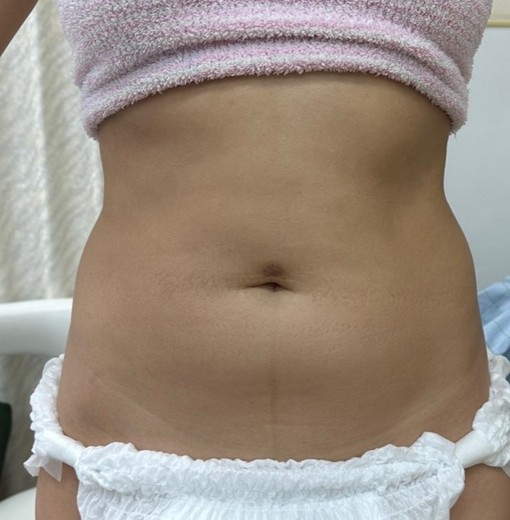before photo: 脂肪吸引(腹部)