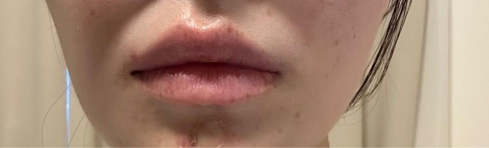 before photo: CO2レーザー, ほくろ除去(レーザー)