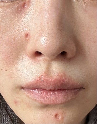 after photo: CO2レーザー, ほくろ除去(レーザー)