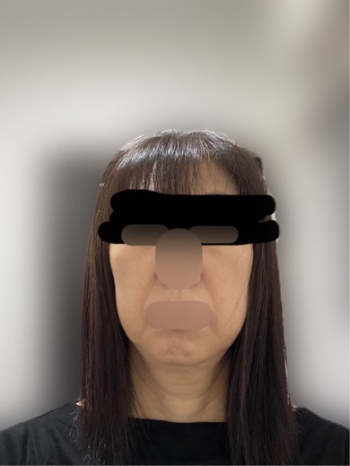 after photo: ハイフ(HIFU)