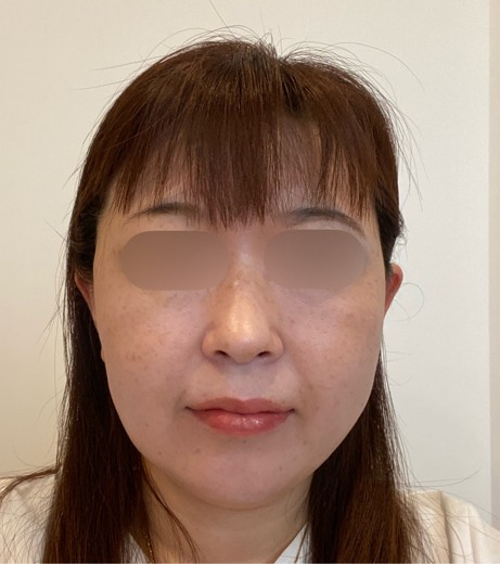 after photo: 脂肪溶解注射(腕), 脂肪溶解注射(顔)