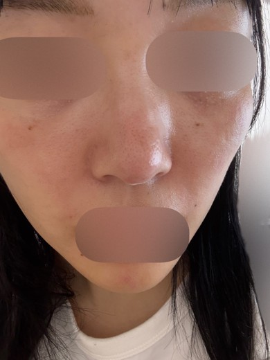 after photo: ピコフラクショナル