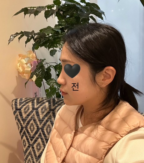 after photo: 코실리프팅