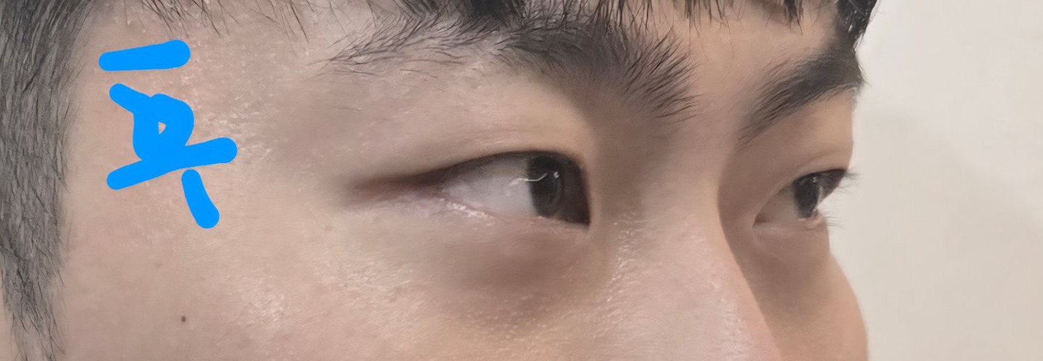 after photo: 입술필러