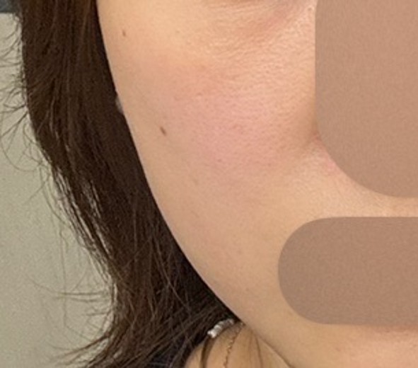 before photo: 온다리프팅